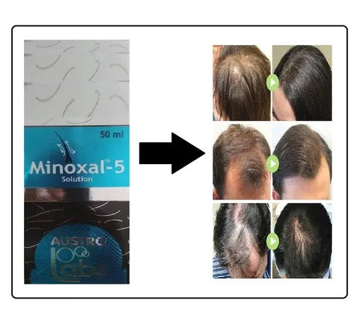 Austro Labs Minoxal hair growth serum in 60ml bottle, showcasing the clear liquid product in a sleek packaging.