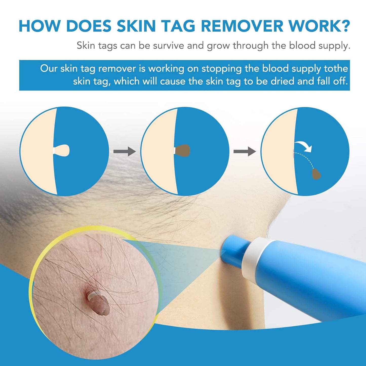 Wukusy Skin Tag Remover Kit 2-in-1 for micro to large skin tags, includes tools for safe removal of 2mm to 8mm skin tags.