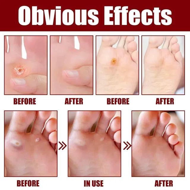 Feet corn removal serum 30ml by 16182, a lip serum product, shown in a sleek bottle with clear labeling and applicator.