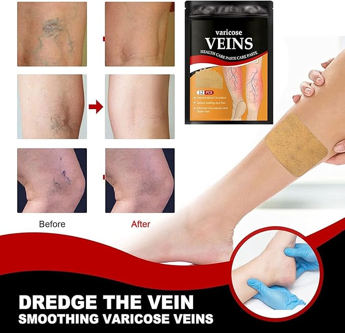 Heat patches for varicose veins treatment, 12-piece set, designed to reduce spider veins and improve leg comfort.