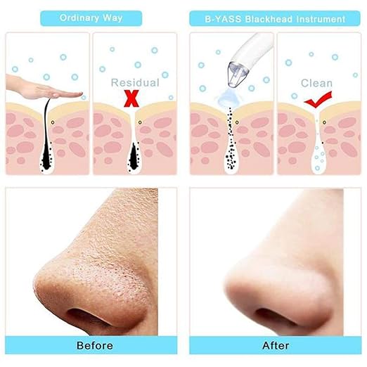 Close-up of the 18277 Derma Suction Cleaner Device, a handheld ear cleaner with a sleek design and suction tip for ear cleaning.