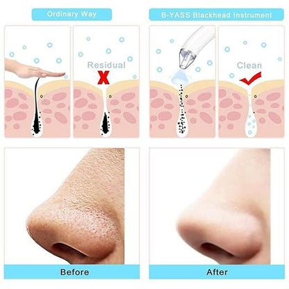 Close-up of the 18277 Derma Suction Cleaner Device, a handheld ear cleaner with a sleek design and suction tip for ear cleaning.