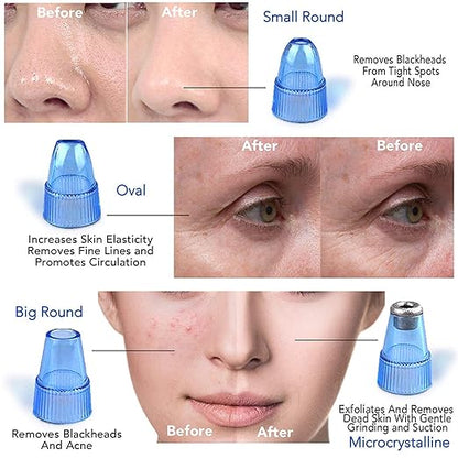 Close-up of the 18277 Derma Suction Cleaner Device, an ear cleaner with a sleek design and transparent tip for ear cleaning.