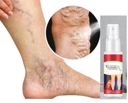 Varcose Venis Spray pack of 2, stretch marks and scar treatment cream with oils, natural skincare product by 5912.