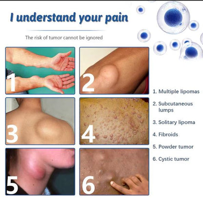 9242 Doctor's No 1 Choice Lipoma Removal Cream for stretch marks and scars, showing the cream tube on a white background.