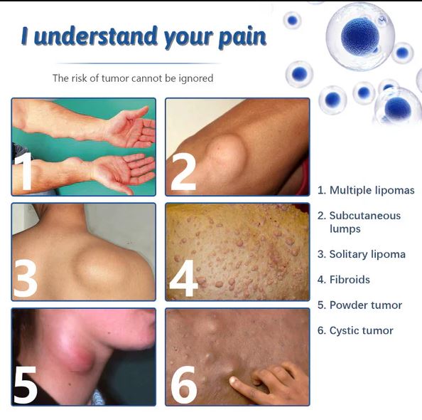9242 Doctor's No 1 Choice Lipoma Removal Cream pack of 2, stretch marks and scar treatment cream with natural ingredients
