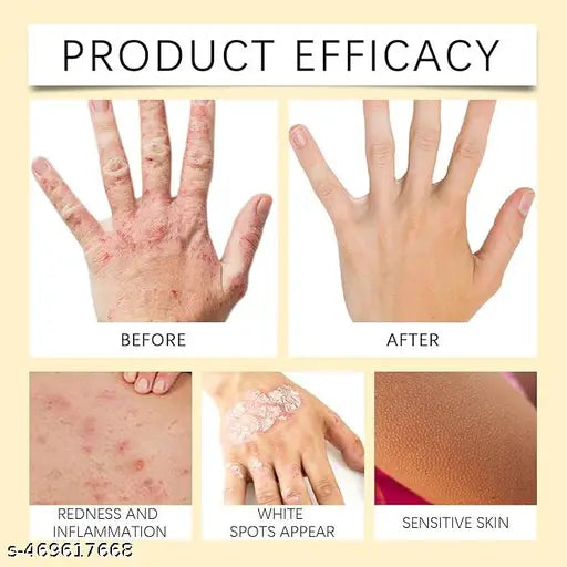 9242 Vitiligo Bee Venom Treatment Cream in a jar, designed for stretch marks and scars, with a natural bee venom formula.