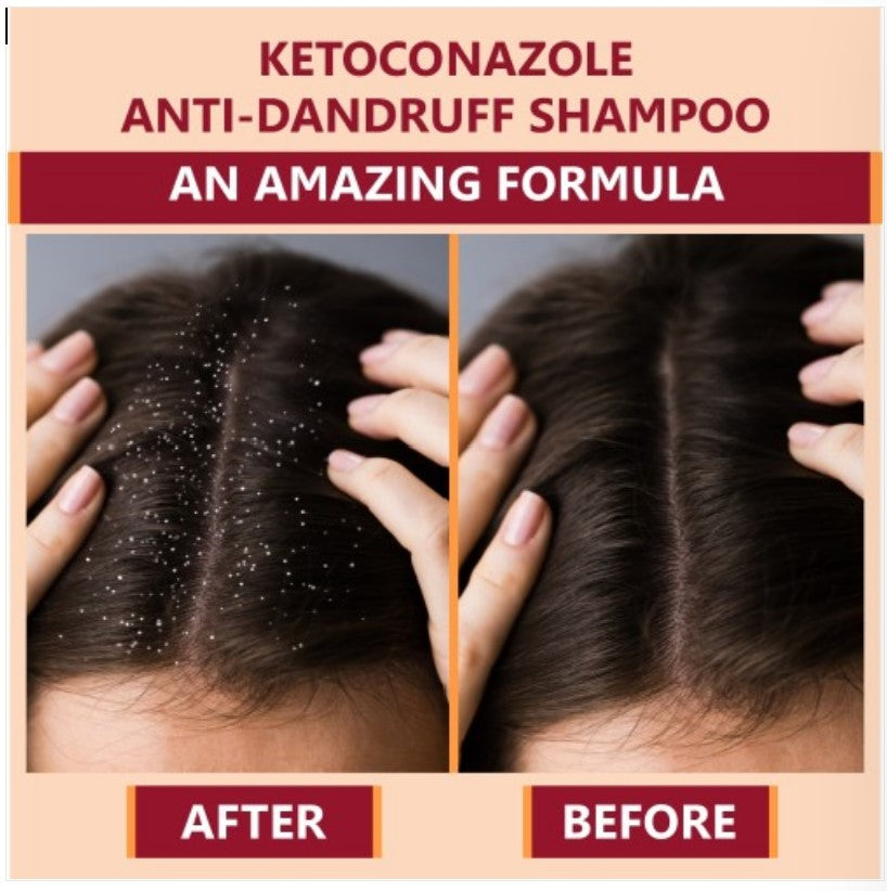 Bottle of 110ml Ketokem anti-dandruff shampoo by 6255 with clear label, shown in a close-up image.