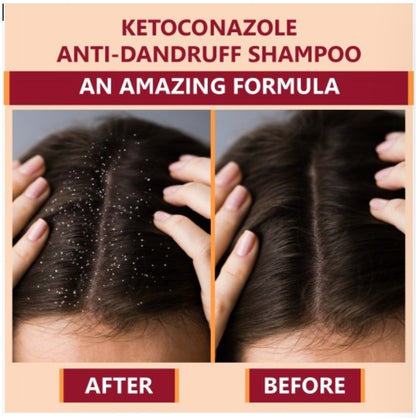 Bottle of 110ml Ketokem anti-dandruff shampoo by 6255 with clear label, shown in a close-up image.