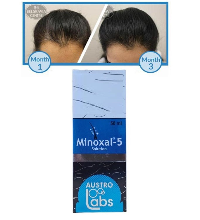 Austro Labs Minoxal hair growth serum in a 60ml bottle, natural-looking hair and applicator tip visible.