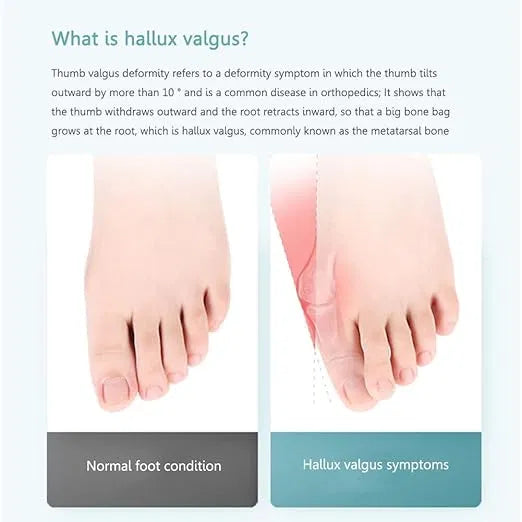 Adjustable toe straightener for men and women displayed with women’s anklets and toe rings on a white background.