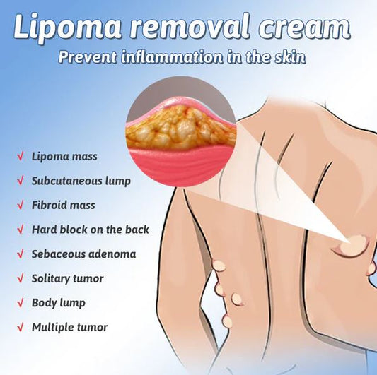 Box of Doctor's No 1 Choice Lipoma Removal Cream for scars and stretch marks from 9242, with the product packaging visible.
