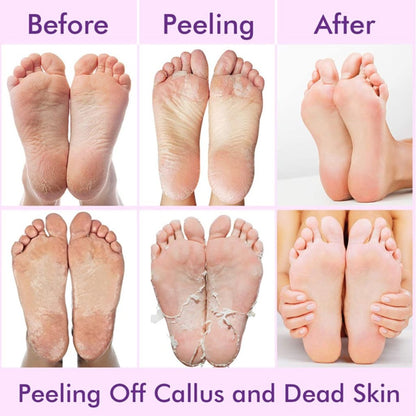 FIZZI SHOP foot peeling mask removing dead skin from heels and soles, exfoliating foot care treatment in a clear container.