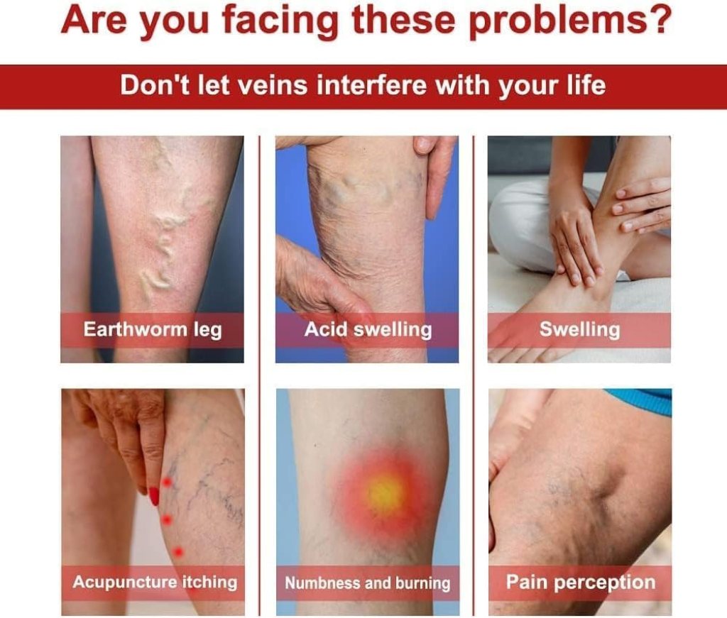 FIZZI SHOP varicose veins patches in a pack of 12, showing discreet adhesive patches for leg and vein relief.