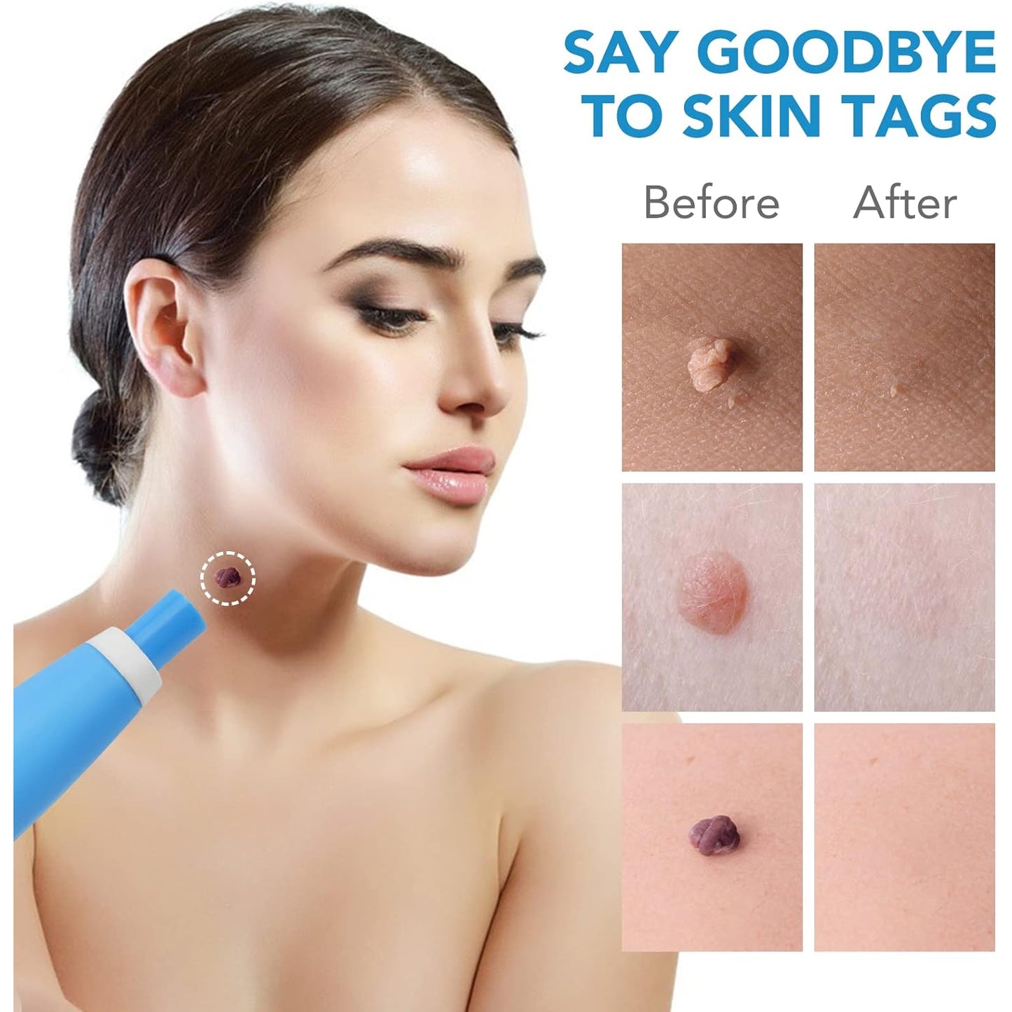 Wukusy Skin Tag Remover Kit 2-in-1 for micro to large skin tags, featuring tools for 2mm to 8mm skin tag removal in a health and beauty set.