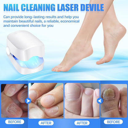 Wukusy rechargeable nail fungus laser device for toenails and fingernails, used for anti-fungal treatment at home.